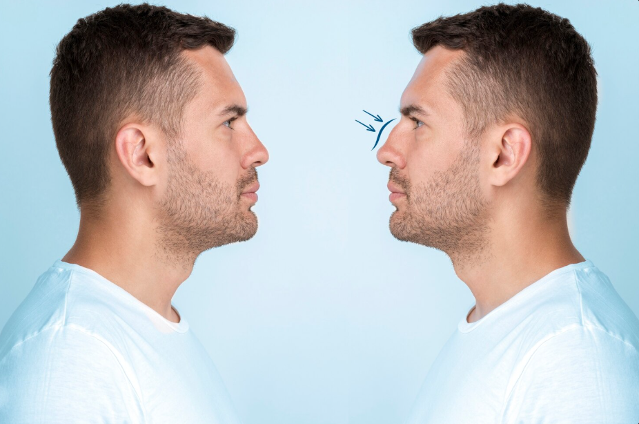 Rhinoplasty is often perceived merely as a cosmetic enhancement, but its true success lies...